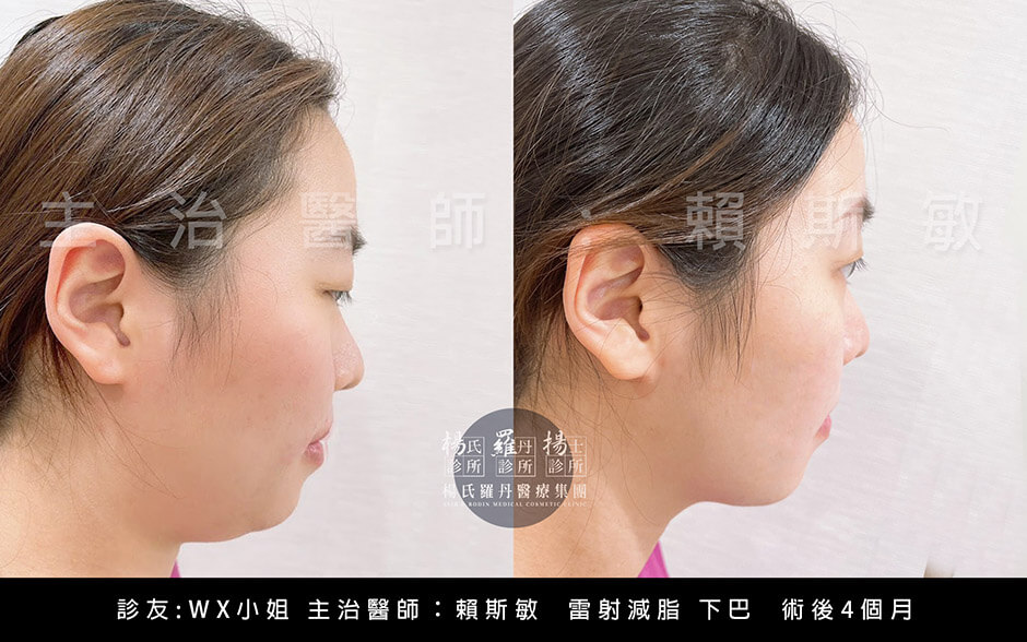 瘦臉 雷射減脂 羅丹 減脂手術 瘦下巴